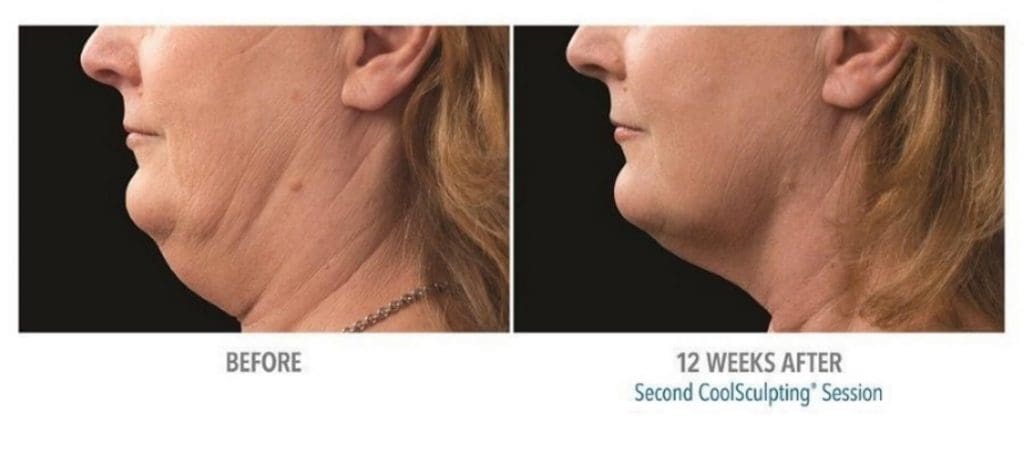 CoolSculpting Before and After: Transformations Revealed- S**** Medical Aesthetics & Anti-Aging