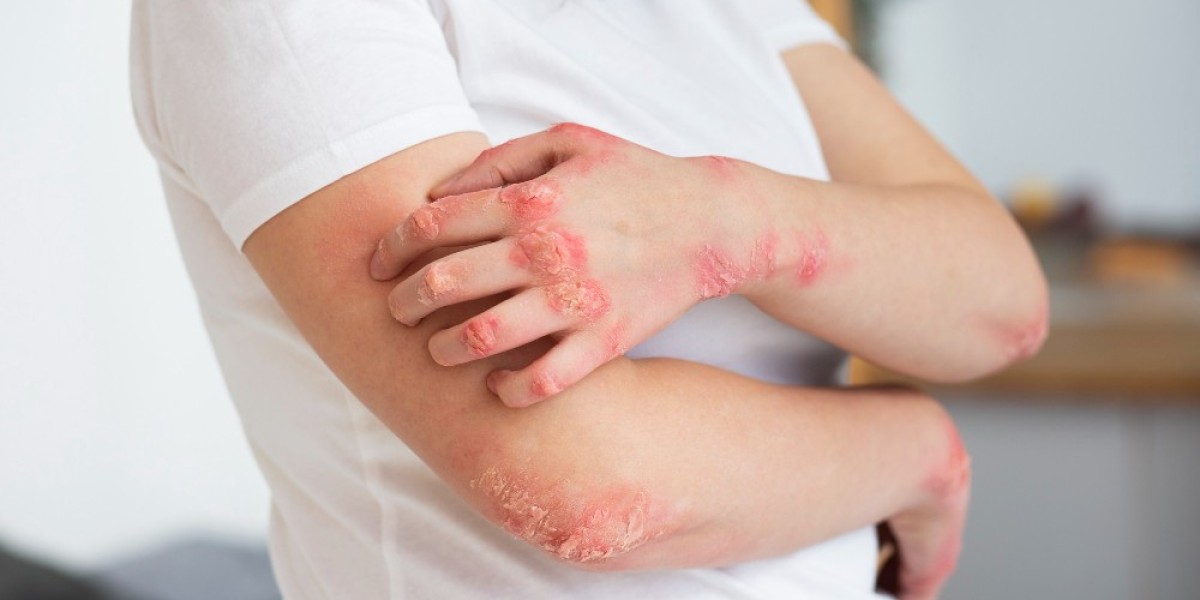 Finding the Best Homeopathy Clinic for Skin Conditions: A Detailed Guide