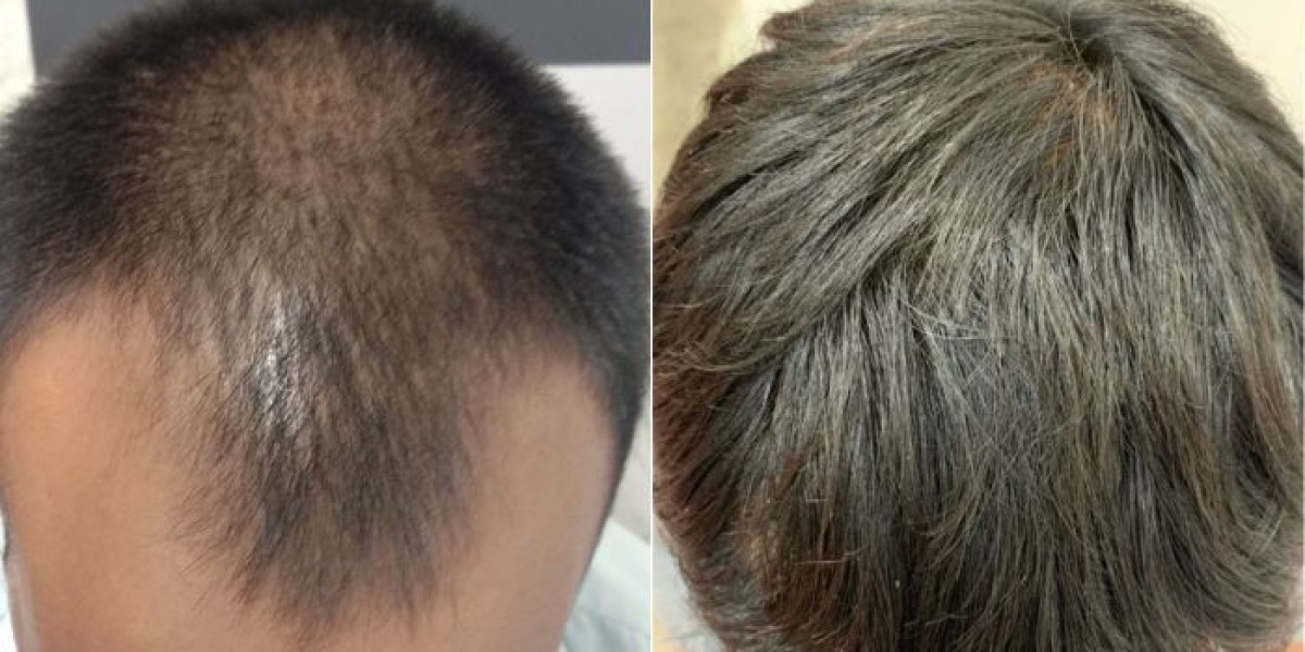 Is Hair Transplant a Painful Procedure?