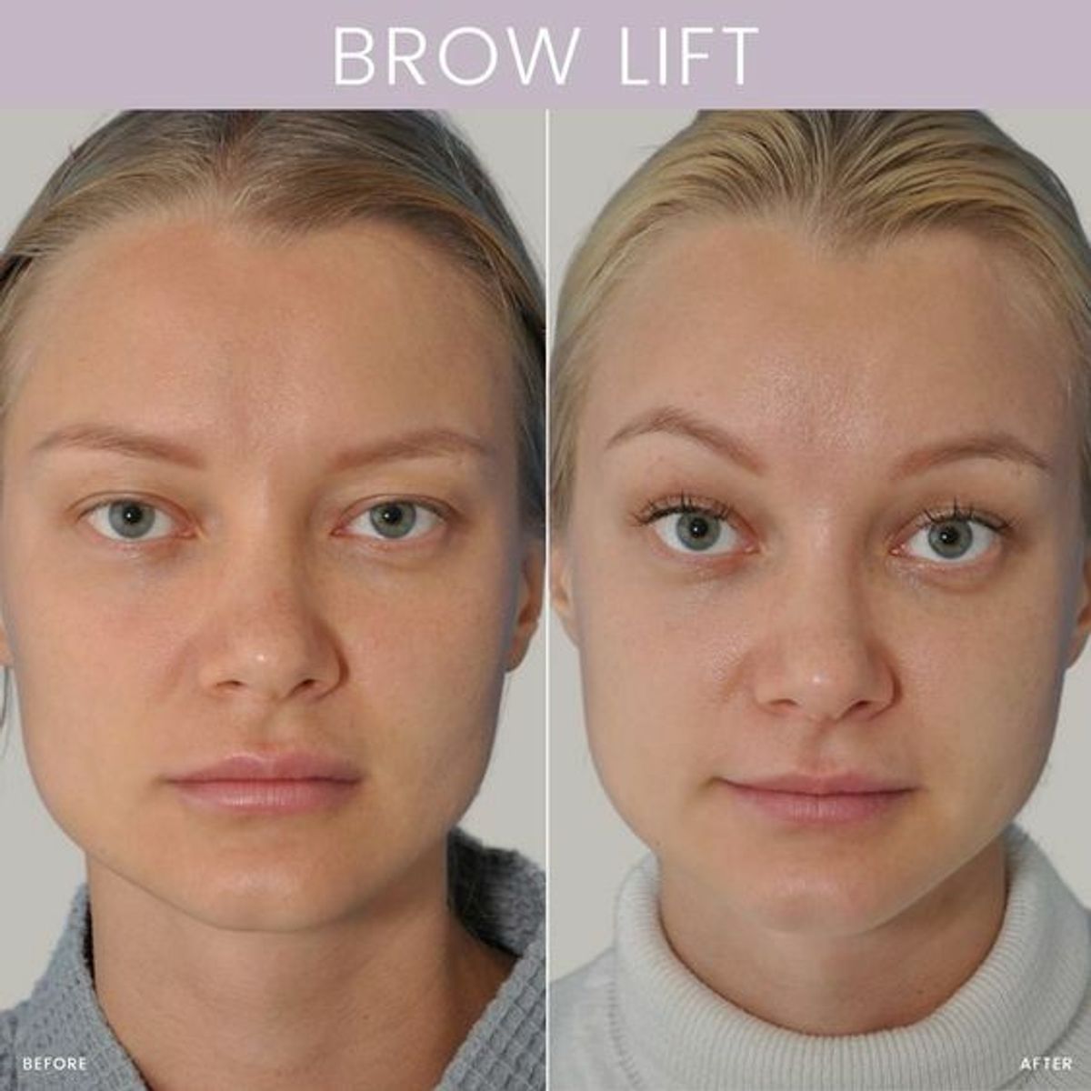 wenkbrauwlift botox (eyebrow lift botox): Get the Perfect Eyebrows Without Surgery — Amelia Rich - Buymeacoffee