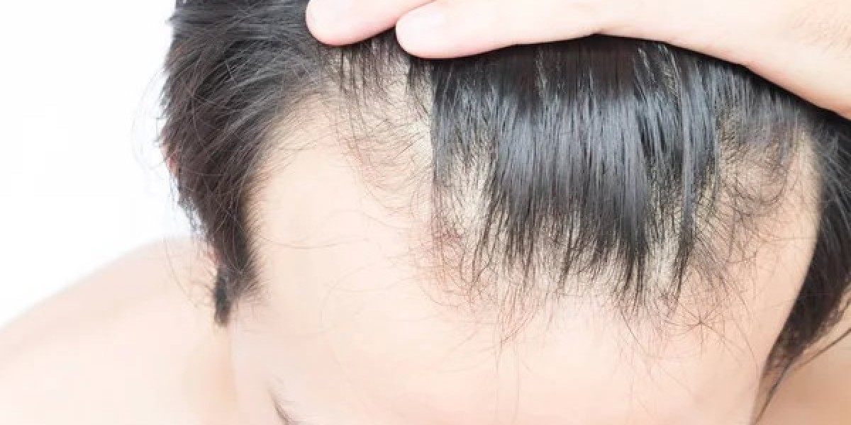 Is a hair transplant a good choice for you?