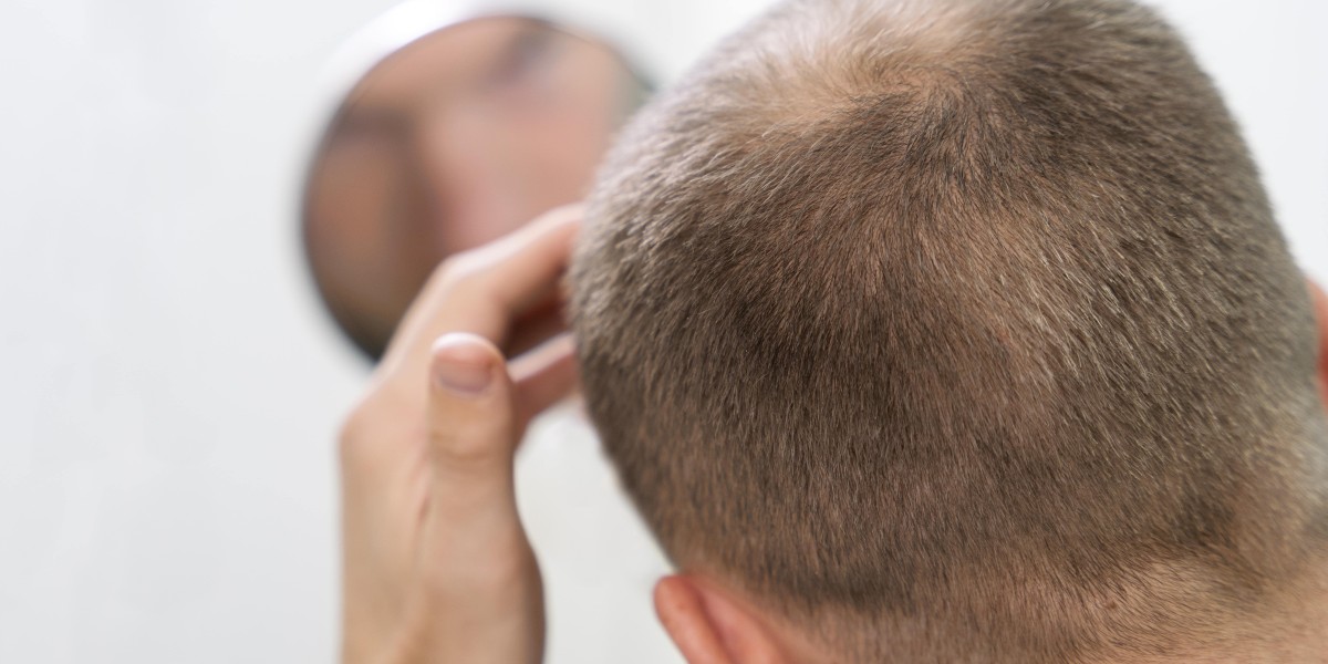 What Kind of Doctor Should You Consult for Hair Loss?