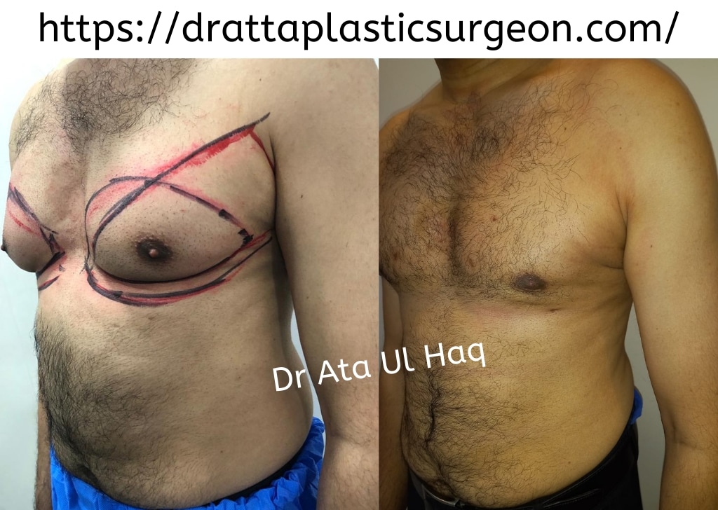Gynecomastia Surgery In La**** - Dr. Ata Best Plastic Surgeon
