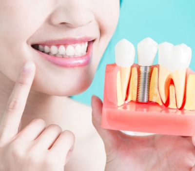 Transforming Your Smile The Benefits of Dental Implants in Hawthorn - Wiki Blog