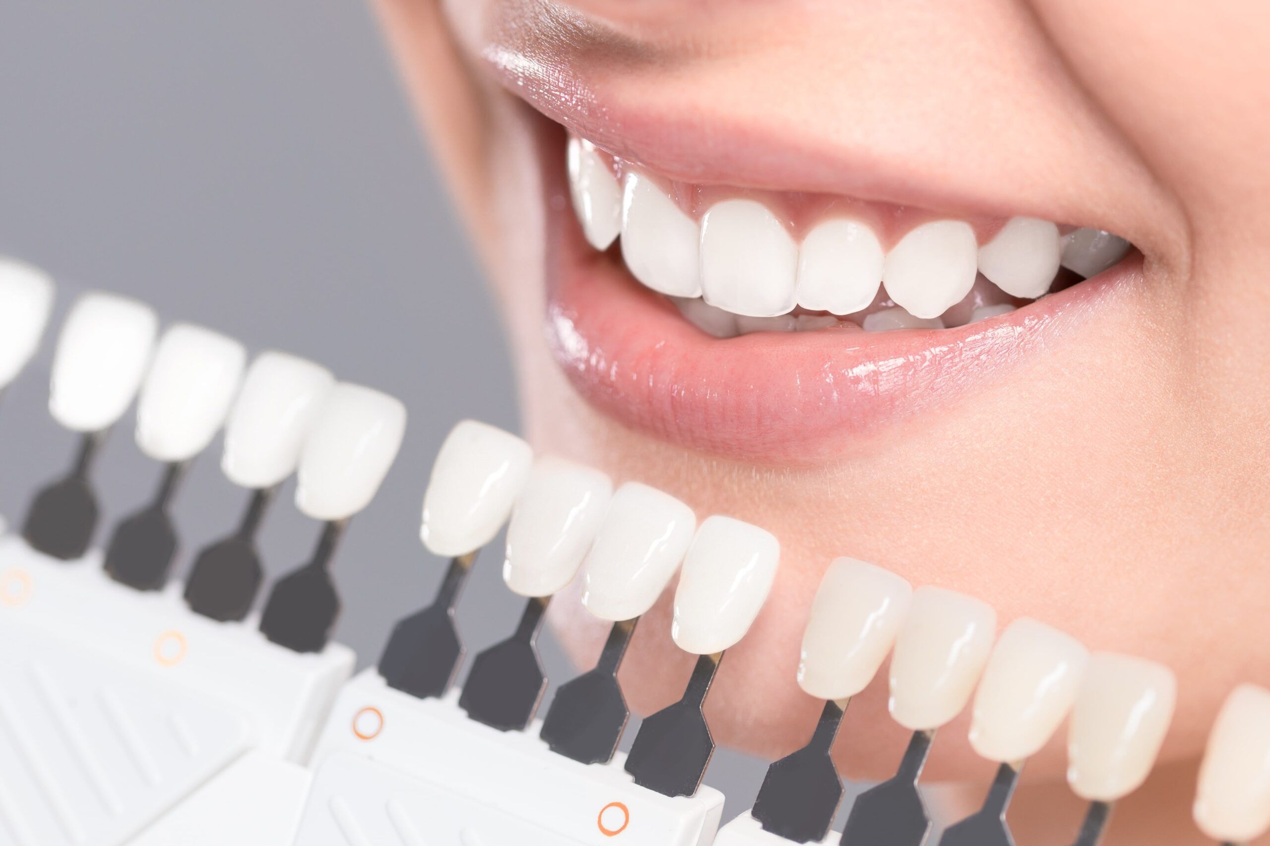 Choosing the Right Shade for Your Dental Veneers: Tips and Tricks - WriteUpCafe.com