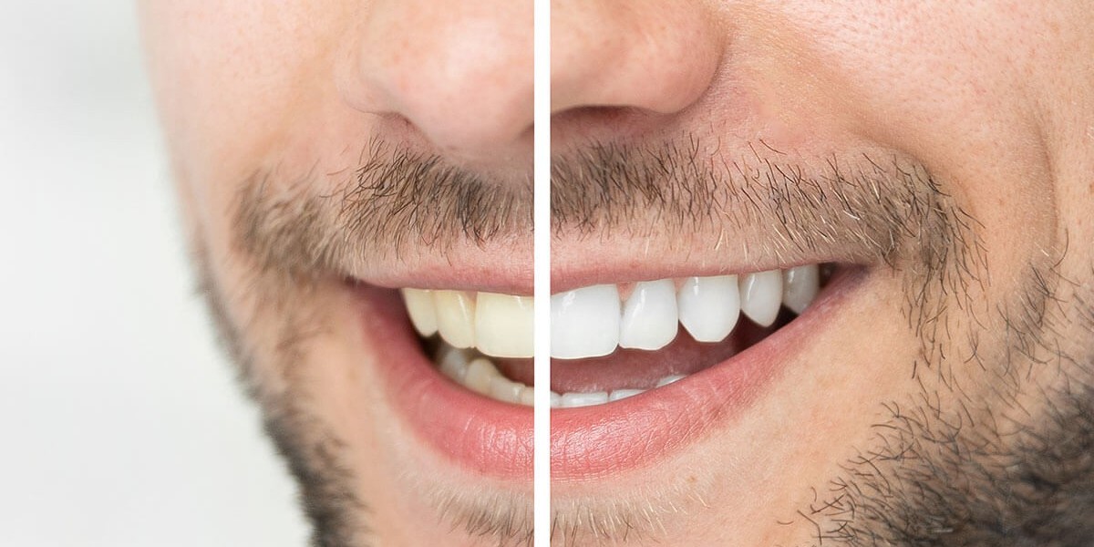 Teeth Whitening Market Size, Share, Demand & Growth Drivers 2024-2031