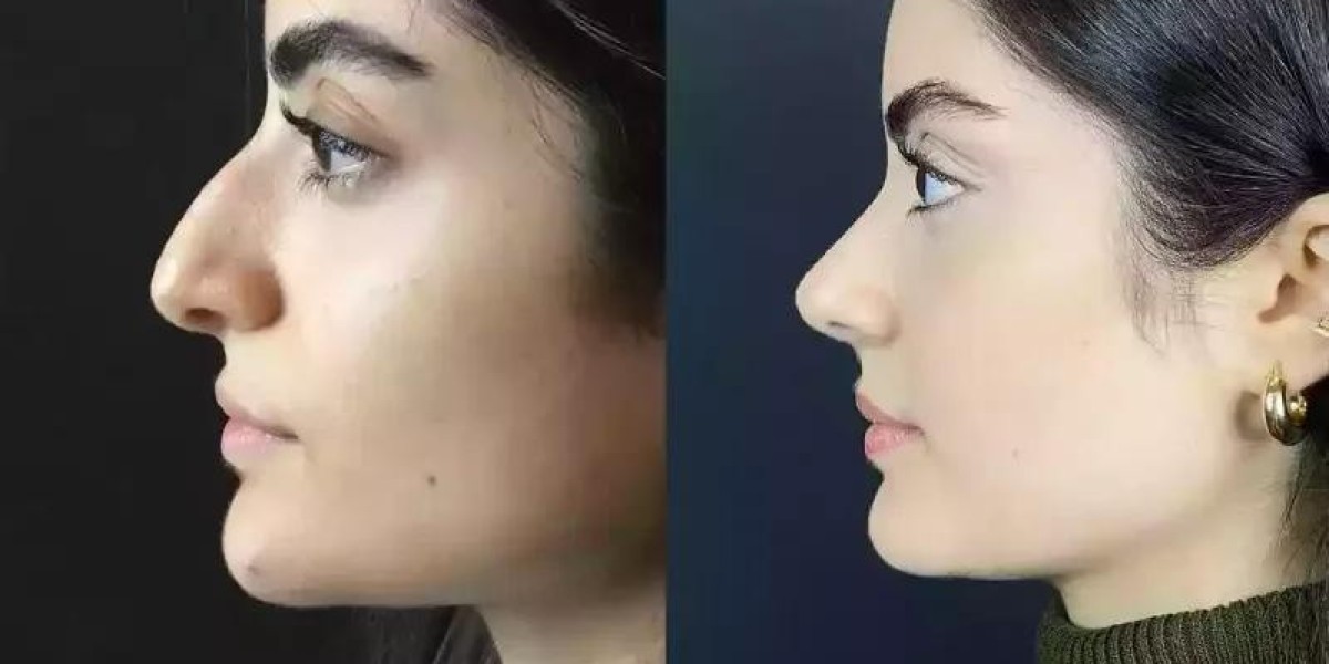 The Impact of Rhinoplasty on Facial Harmony and Balance