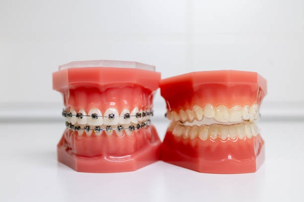 Comparing Invisalign and Braces – Pros and Cons – Telegraph