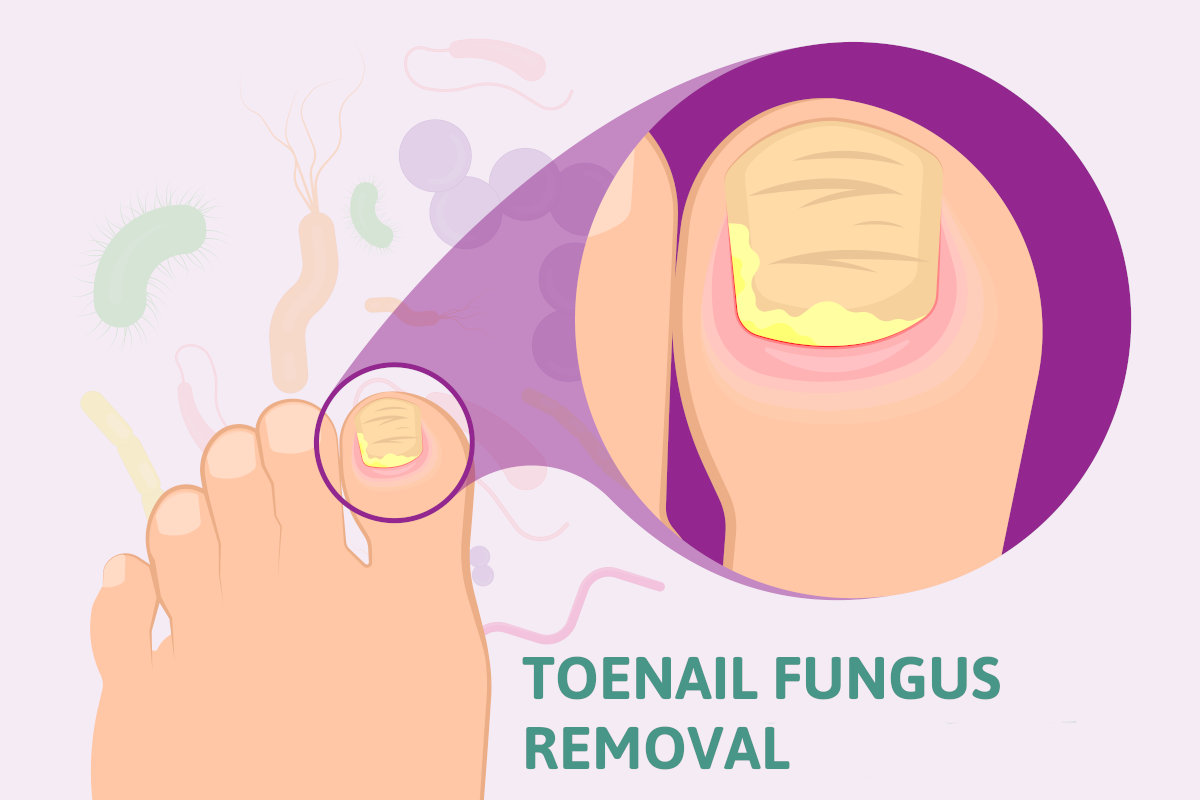 Toenail Fungus Removal can be cured with our treatments.