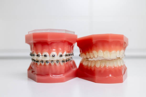 Comparing Invisalign and Braces – Pros and Cons