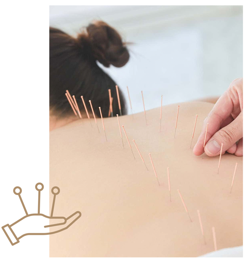 Effective Dry Needling Therapy and Acupuncture in Sydney - Maxwell's Smart Health