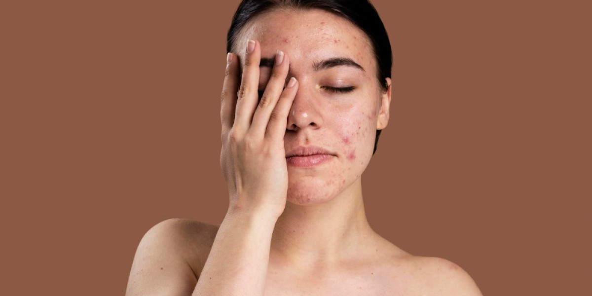 Clear Skin Naturally: How Homeopathic Remedies Effectively Treat Acne and Pimples