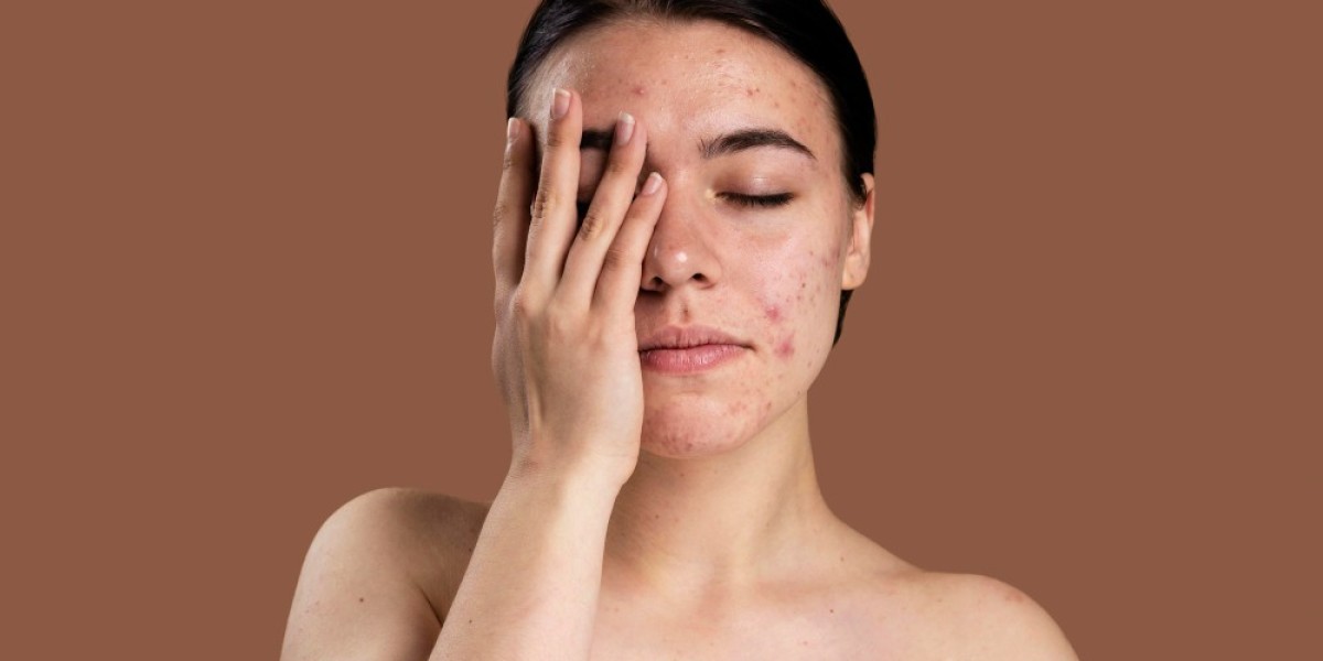 A Comprehensive Guide to Treating Acne Naturally with Dharma Homoeopathy