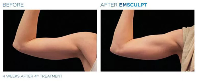 Emsculpt Dubai: A Trendy New Way to Sculpt Your Body