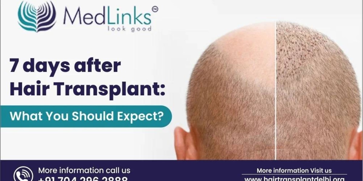 7 Days After Hair Transplant: What You Should Expect