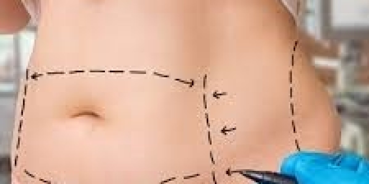 Liposuction Surgery in Dubai: Your Guide to Transformation