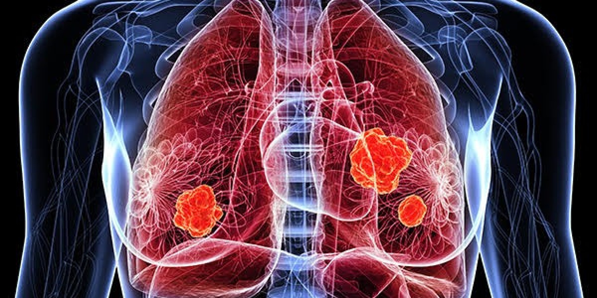 Extensive-Stage Small Cell Lung Cancer Market Size 2024 | Forecast till 2034