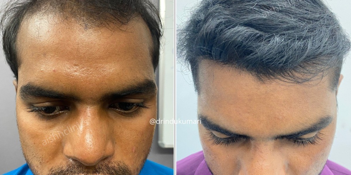 Hair Restoration in Delhi: A Comprehensive Guide