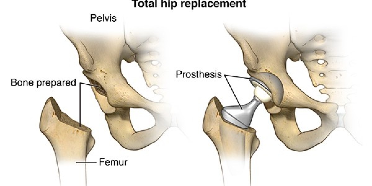 Hip Replacement Surgery: A Patient's Perspective