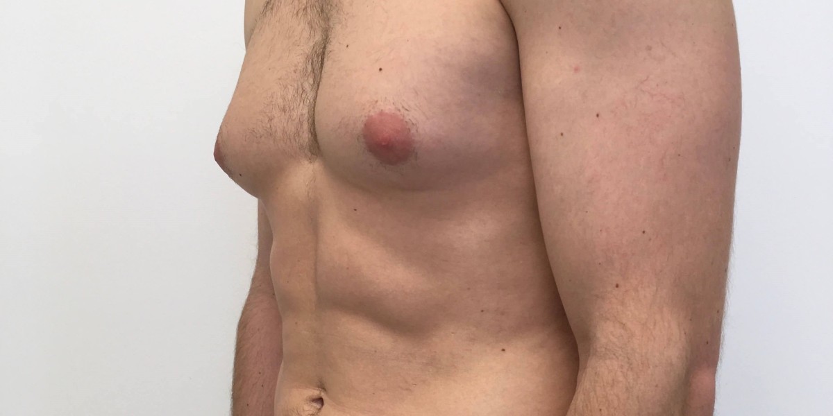 Understanding the Recovery Process After Gynecomastia Surgery